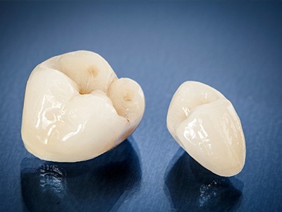 Two tooth-colored dental crowns