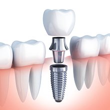 Animation of implant crown