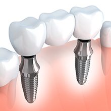 Animation of implant birdge