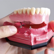 Model implant supported denture