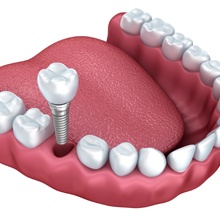Animation of dental implant process
