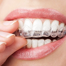 Closeup of patient placing Invisalign tray