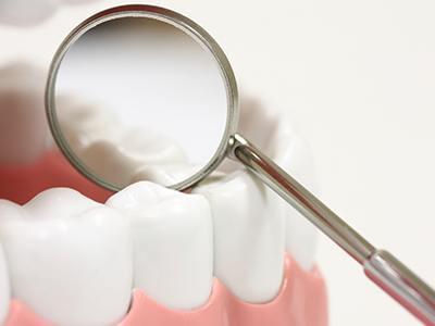 Closeup of teeth with dental sealants