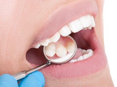 Closeup of patient receiving dental exam