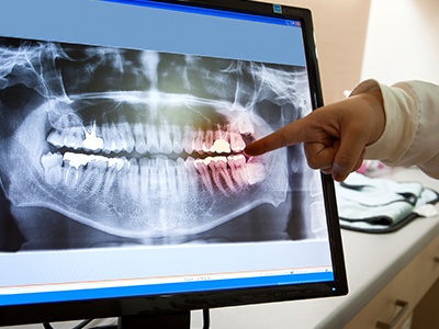 Panoramic digital x-rays